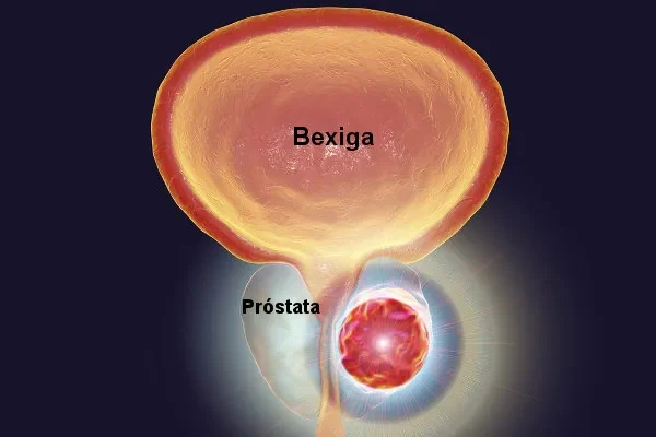 cancer-prostata